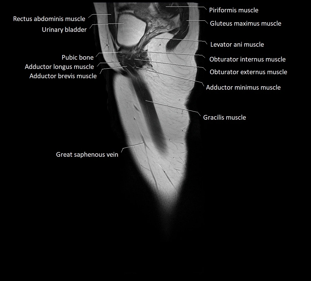 Thigh sagittal cross sectional anatomy MRI 3T image 21.webp